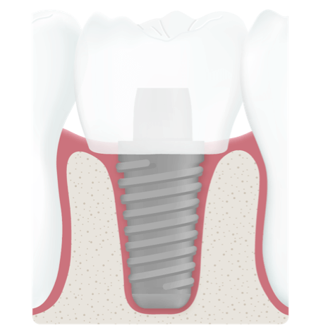 alterszahnmedizin implantat