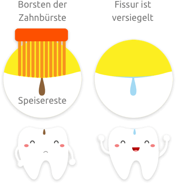 prophylaxe fissurenversiegelung