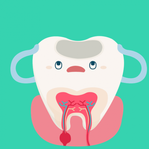 Milchzahnendodontie Schritt 2