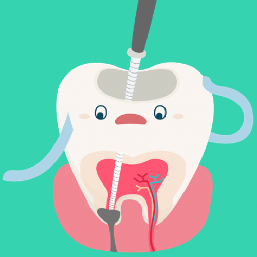 Milchzahnendodontie Schritt 3