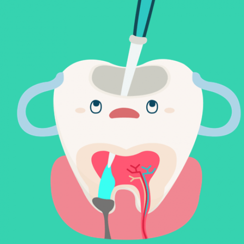 Milchzahnendodontie Schritt 4