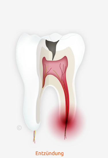 Praevention Endo Step 1