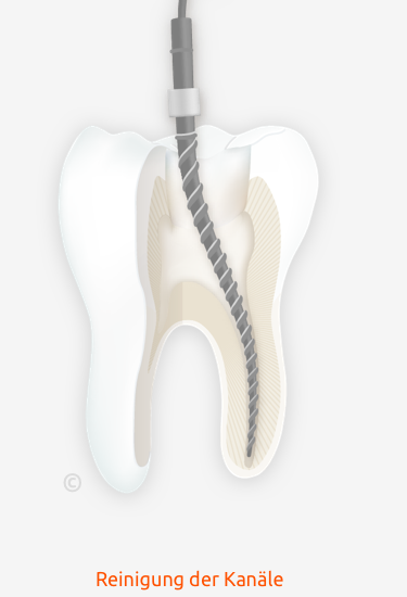 Praevention Endo Step 2