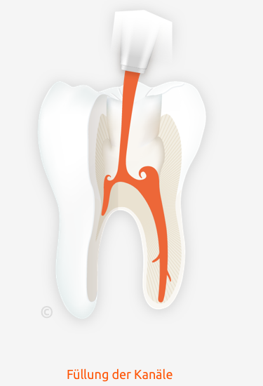 Praevention Endo Step 3